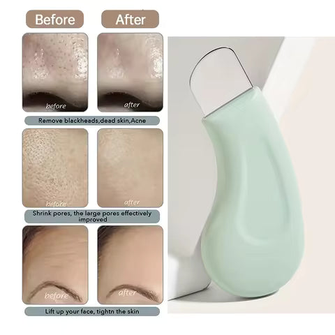 Blackhead and Whitehead Removal Tool for Nose and Face - Skin Pore Cleaner, Skin Care Tools for Women